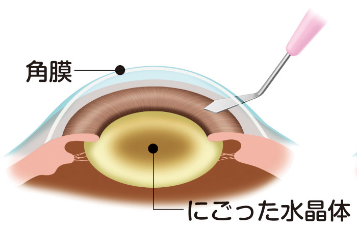 経結膜一面切開